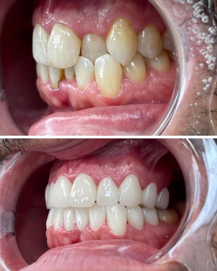 I pride myself in making the most natural straight teeth possible…that look fucking good! #instagood #transformation #makeover